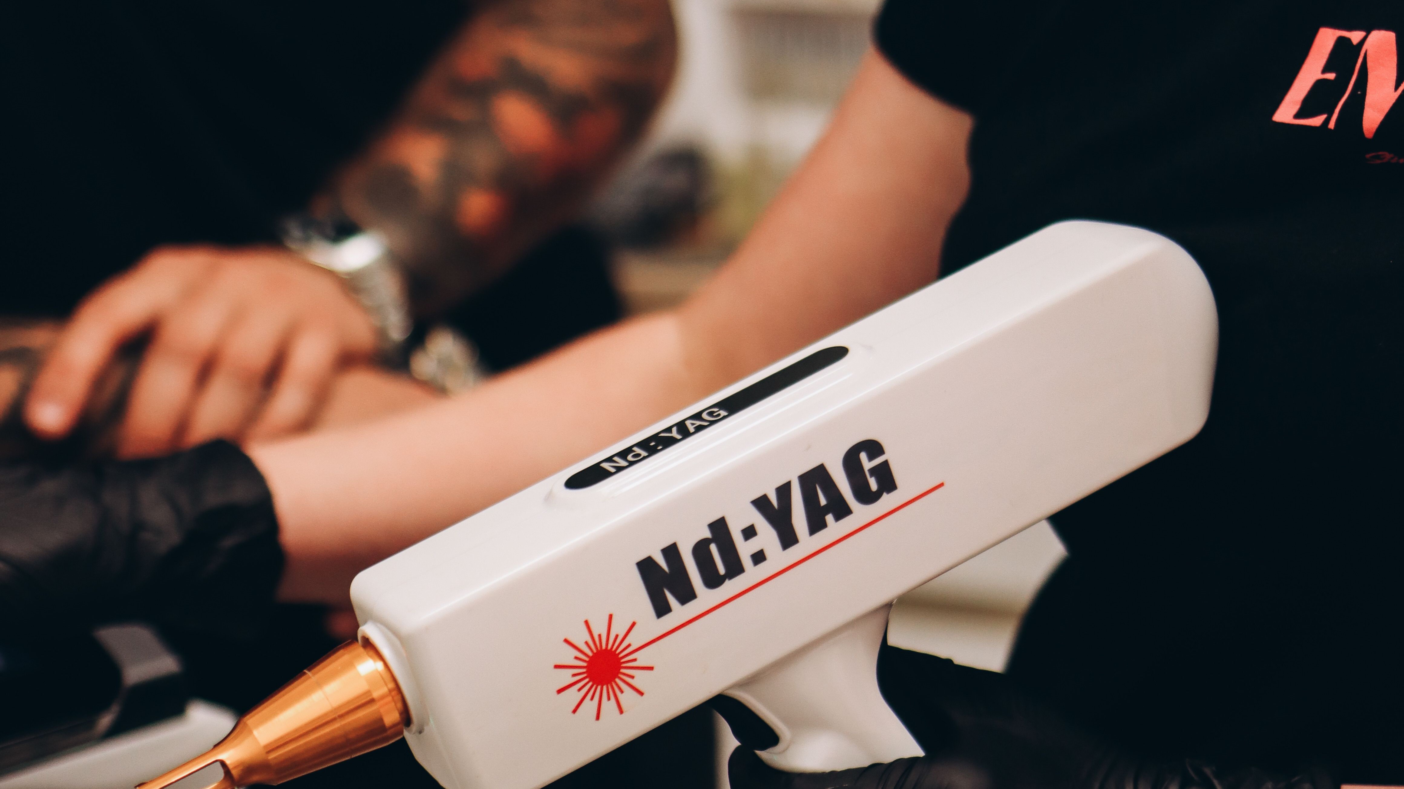 Procedimento de remoção de tatuagem a laser em clínica